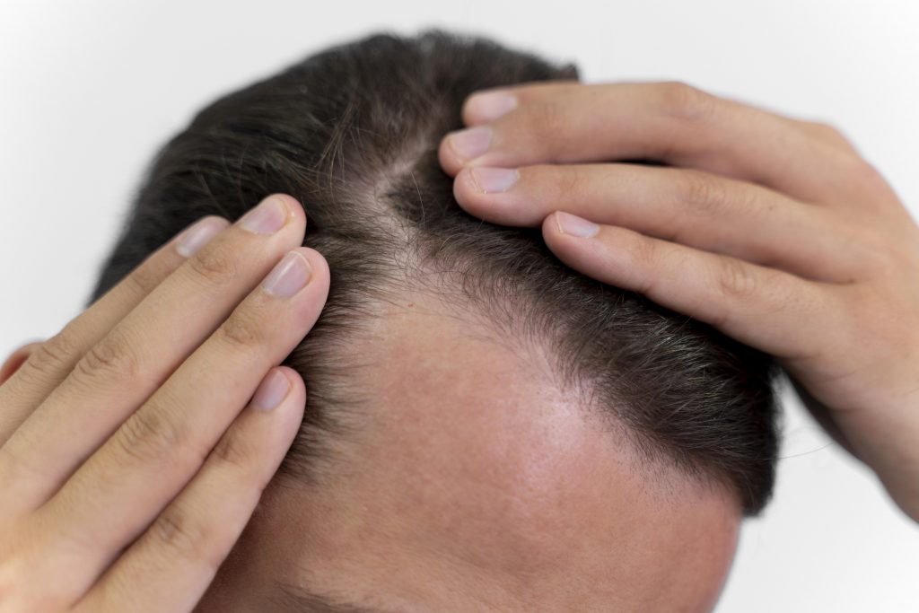 Adult male looking at his hair with alopecia