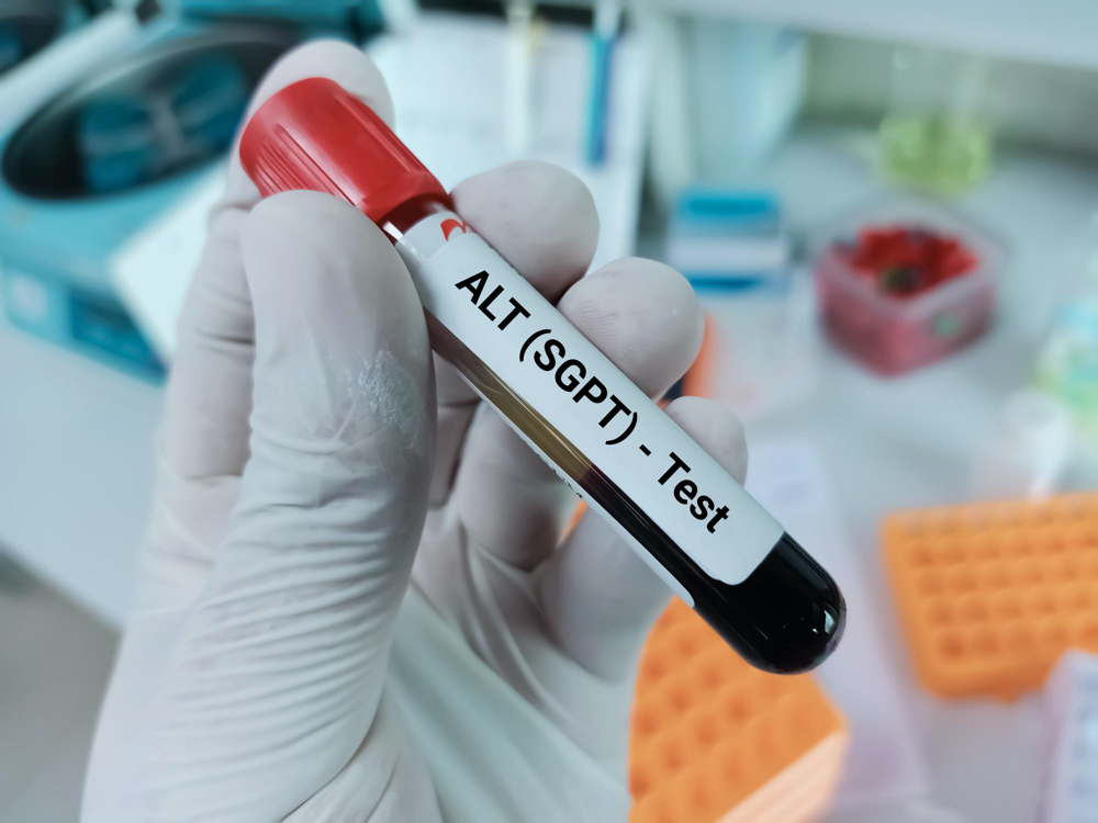 Scientist holds blood sample for serum alt (sgpt) test. liver function test.
